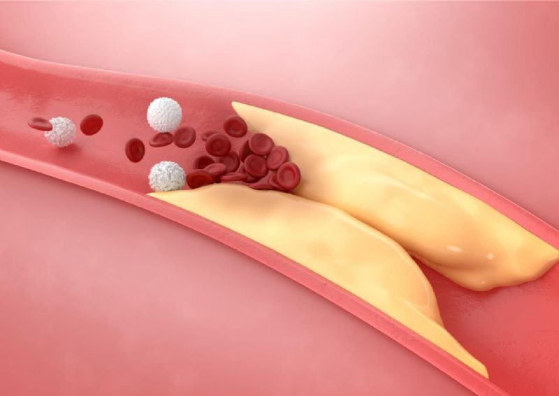 預防心血管事件新利器！PCSK9抑制劑