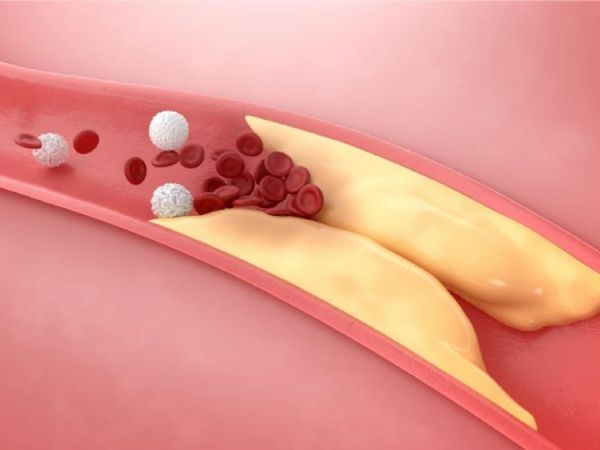 預防心血管事件新利器！PCSK9抑制劑